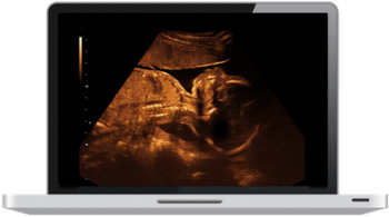 Laptop showing video captured from an ultrasound machine